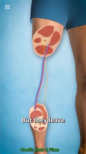 Rotationplasty – The Backwards Leg Surgery #3danimation