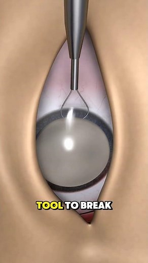 Cataract Surgery 3d animation #EyeCare #eyehealth #visionrestoration