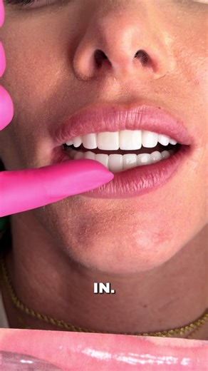 Understanding Bite Openings in Dental Treatments