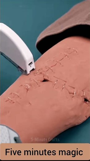 How to Repair a Broken Leg Bone (Like a Pro!) 💪"