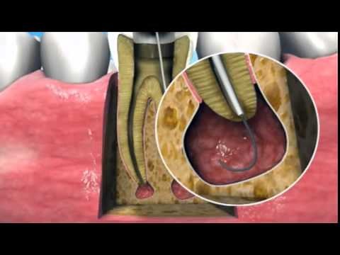 Nonsurgical management of periapical lesions