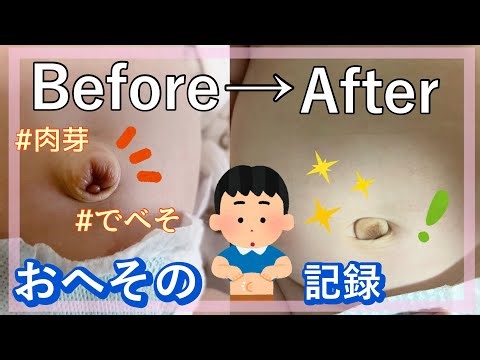 【でべそが治りました！】おへその記録完結編／でべそ／肉芽