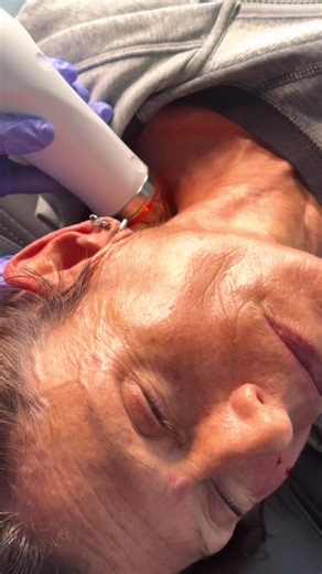 Secret RF Microneedling is an innovative cosmetic procedure designed to rejuvenate and enhance the skin's appearance. Here's a breakdown of how it works: Microneedling Technology: Secret RF utilizes microneedling, a technique that involves tiny, sterile needles creating controlled micro-injuries in the skin's surface. These micro-injuries stimulate the natural healing process, triggering the production of collagen and elastin, which are essential for maintaining skin elasticity and firmness. Rad