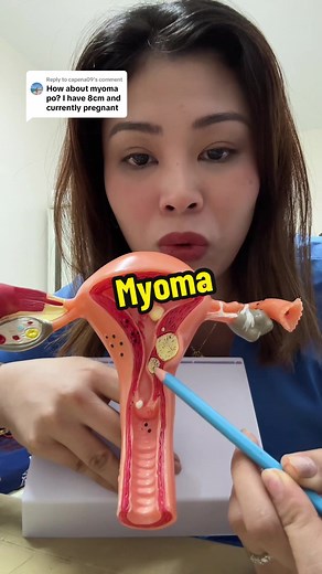 Understanding Myoma: Causes, Symptoms, and Treatment Options