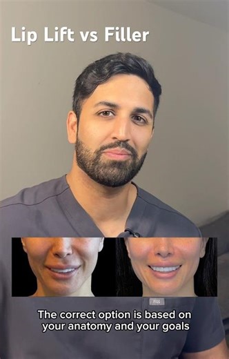 Lip Lift vs Lip Filler — What’s the Difference?