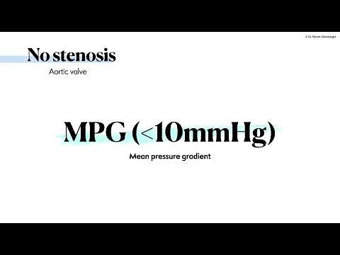〖Echocardiography〗 Aortic valve - normal measurements