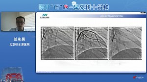 CTO手术演示病历回顾