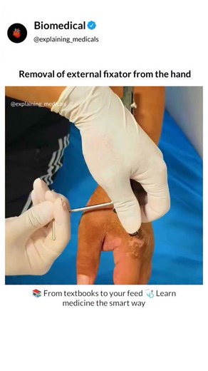 Explaining Medicals on Instagram: "Follow @explaining_medicals ⬇️⬇️⬇️⬇️ What text books can't show you, We animate. The medical process of removing an external fixator from the hand. It covers why external fixators are used in fracture treatment, precautions during removal, possible discomfort, and the importance of post-removal care, including physiotherapy and wound management, to ensure proper healing and functional recovery. . . . . . 📝 | Hard Concepts, Simplified in 30 Seconds 📚 | Tired O