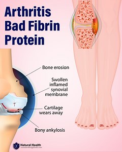 The Sticky “Glue” Protein Fibrin is a sticky protein accumulating inside the body's joints that may cause arthritis pain and stiffness - as well as other health issues. Here is why fibrin matters and how to deal with it: https://go.worstarthritisfoods.com/intspFibrin | Healthy Back Institute