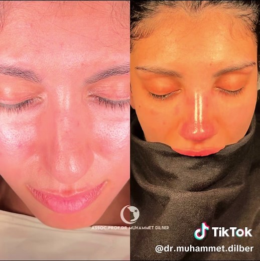 Transformative Nose Surgery Results: Rhinoplasty Journey