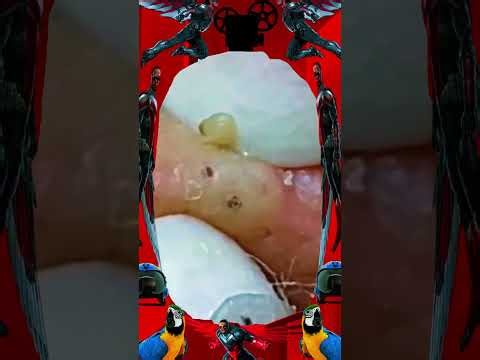 Blackheads Removal | old aged blackheads removal/ cystic blackheads whiteheads removal
