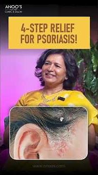 Itchy, Flaky Scalp? Try This 4-Step Psoriasis Treatment #psoriasis #healthyscalp #anoos