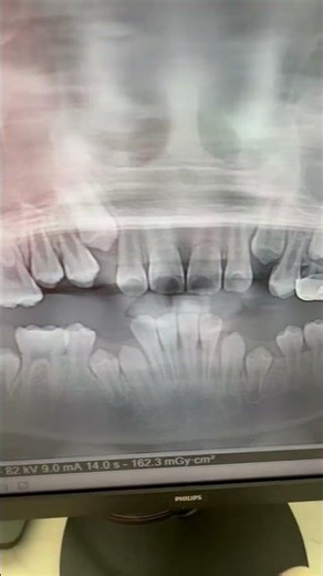 Baby Tooth Lost Too Early? How Adult Molars Shift | Orange County Orthodontist