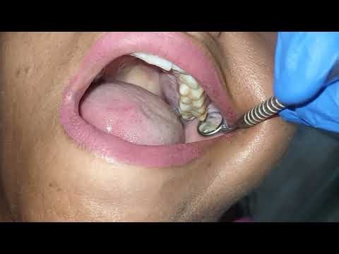 Upper wisdom tooth 😫? Part 1