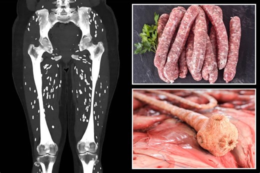 Horrific scan shows the disturbing effects of undercooked pork on the body