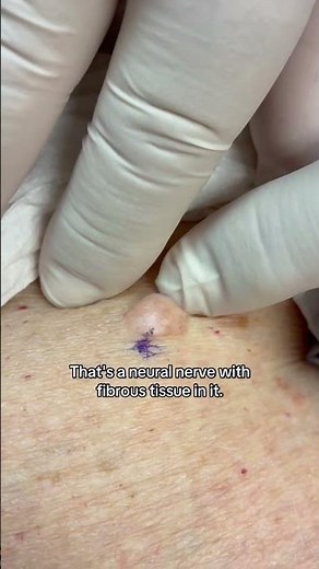 Dermatologist with 50 years of experience shows what a neural fibroma looks like (pt 1)