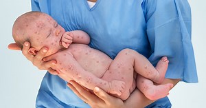 Odra. 10 rzeczy, które powinieneś wiedzieć o tej groźnej chorobie