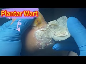 [ASMR] 1 Hour of Deep Plantar Wart Removals – Full Foot Transformations!