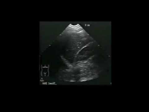 Focused assessment with sonography for trauma FAST ATLS