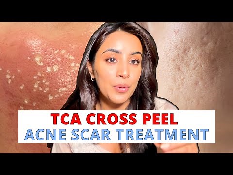 TCA Cross ( Acne Scar Treatment )