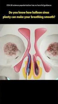 Balloon Sinuplasty Procedure - To Open Blocked Sinus Passages#balloonsinuplasty #sinuplastreatment