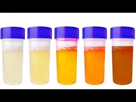 Was die Farbe des Urins über die Gesundheit verrät!
