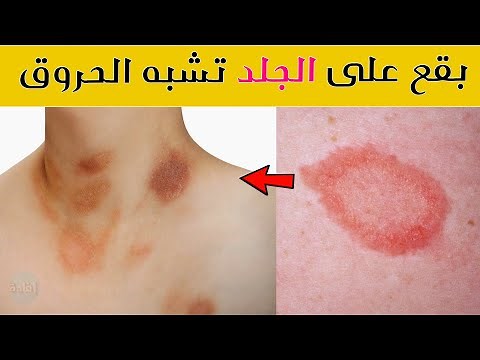 ظهور بقع على الجلد تشبه الحروق
