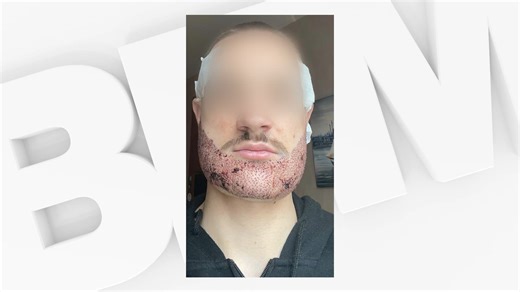 "C'était ingérable": un étudiant se suicide après une greffe de barbe ratée en Turquie