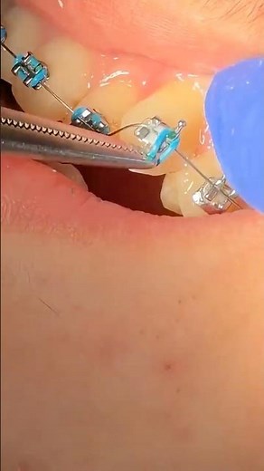 FULL BRACES! Tooth Time Family Dentistry