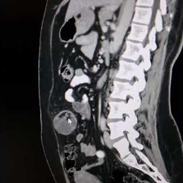 Lymphangioma vs mesenteric cyst.