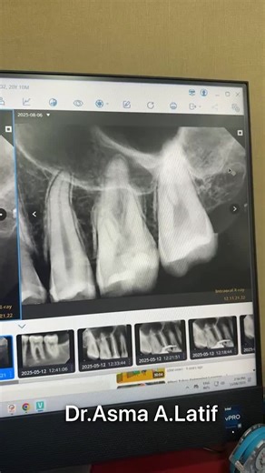Symptomatic Irreversible Pulpitis treated with RCT | Dr.Asma AbdulLatif posted on the topic | LinkedIn