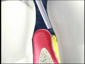 Arestin used to fight Periodontal Disease Delray Beach Dentist