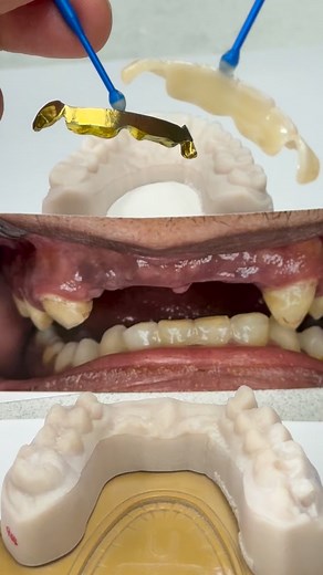 Great solution for super long span pontic! | CEO Luke Kahng