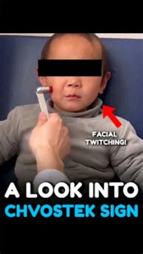 Chvostek Sign | Hypocalcemia Test | Nursing Skills Videos| nursing airport NA