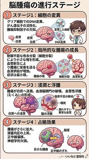 脳腫瘍の恐ろしい進行ステップ！なぜステージ2まで症状が出にくいのか？血管新生と脳浮腫の危険性