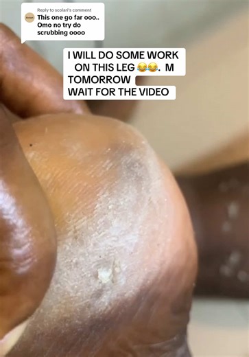 ASMR Dead Skin Leg Treatment