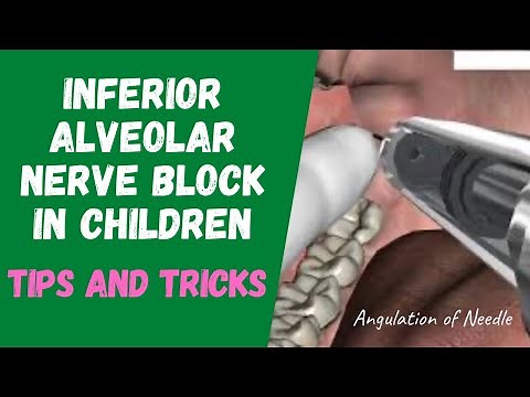 Inferior Alveolar Nerve Block in Children | tips and tricks | live
