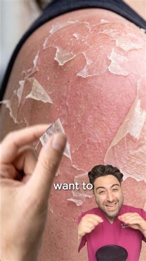 Should you PEEL OFF Sunburned Skin?