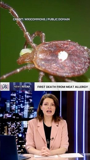 Deadly Tick Linked Meat Allergy