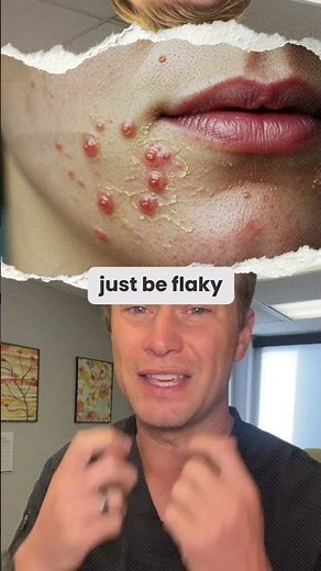 Is toothpaste good for acne?? #acne #toothpaste #fyp #pimples #remedy #naturalremedy