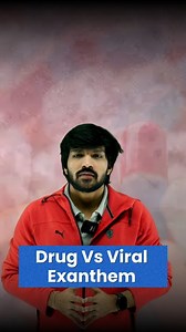 Drug Vs Viral Exanthem Differentiating Drug Exanthem vs. Viral Exanthem! 🕵️‍♂️ rashes A patient comes in with an acute maculopapular rash. Is it a drug reaction or a viral one? Differentiating is KEY for proper management! 💡 How to Differentiate: Viral Exanthem Clues: Progression: Often spreads cephalocaudally (from head/neck down to the body). Associated Symptoms: Look for accompanying lymphadenopathy (swollen lymph nodes). Action: No specific drug needed, mostly supportive care. Drug Exanthe