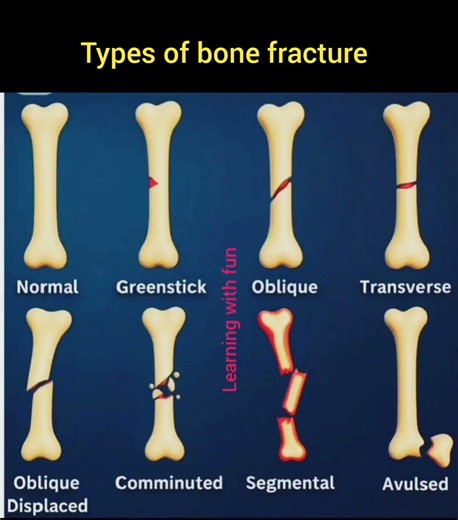 Types of bone fracture!!🥰 yt shorts #trending #languagelearning #vocabs# shortsfeed # learning#viral