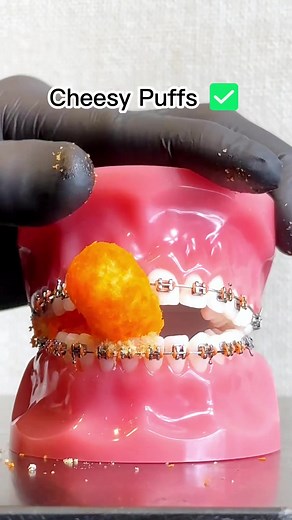 Can You Eat Cheetos with Braces? Brackets Tips for Snacking