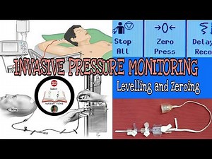 Zeroing, Levelling-Intra arterial, Central venous, Intracranial, Intra-abdominal pressure monitoring