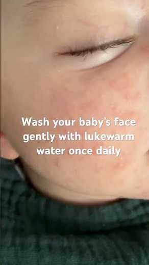 Newborn face spots or acne #newborncare #newmom #motherhood