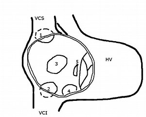 Sinus venosus atrial septal defect - Alchetron, the free social encyclopedia