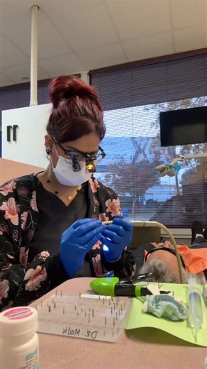 Pt came in with broken teeth, cavities, mobility. Ext 23-26 and left with temporary 6 unit bridge. #ef #dentalcare #bridge #transformation #viraltiktok