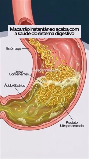 Academia do Jejum on Instagram: "⚠️ Parece prático… mas o preço é alto para o intestino e a saúde como um todo: ❌ 1. Irritação intestinal Esse tipo de macarrão é cheio de óleos de baixa qualidade e aditivos artificiais, que agridem a parede do intestino e podem agravar quadros como colite, gastrite e má digestão. ❌ 2. Desequilíbrio na flora intestinal Com muito sódio e conservantes, o miojo cria um ambiente ruim para as bactérias boas. Isso diminui a diversidade da microbiota e pode causar gases