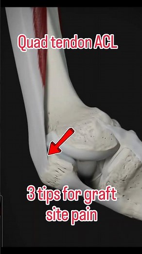 Quad Tendon ACL - 3 Tips for Graft Site Pain (Tendinitis)