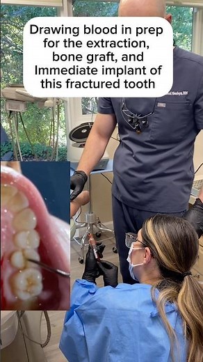 🩸 Tooth Extraction, PRF & Implant Preparation in Walnut Creek, CA #implants #prf #extraction